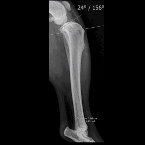 Nivellement du plateau tibial Radio pré opératoire