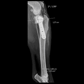 Nivellement du plateau tibial Radio post opératoire